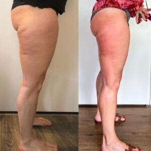 Transformational Cupping ®. Cupping Resultaat. De Afslank Studio.